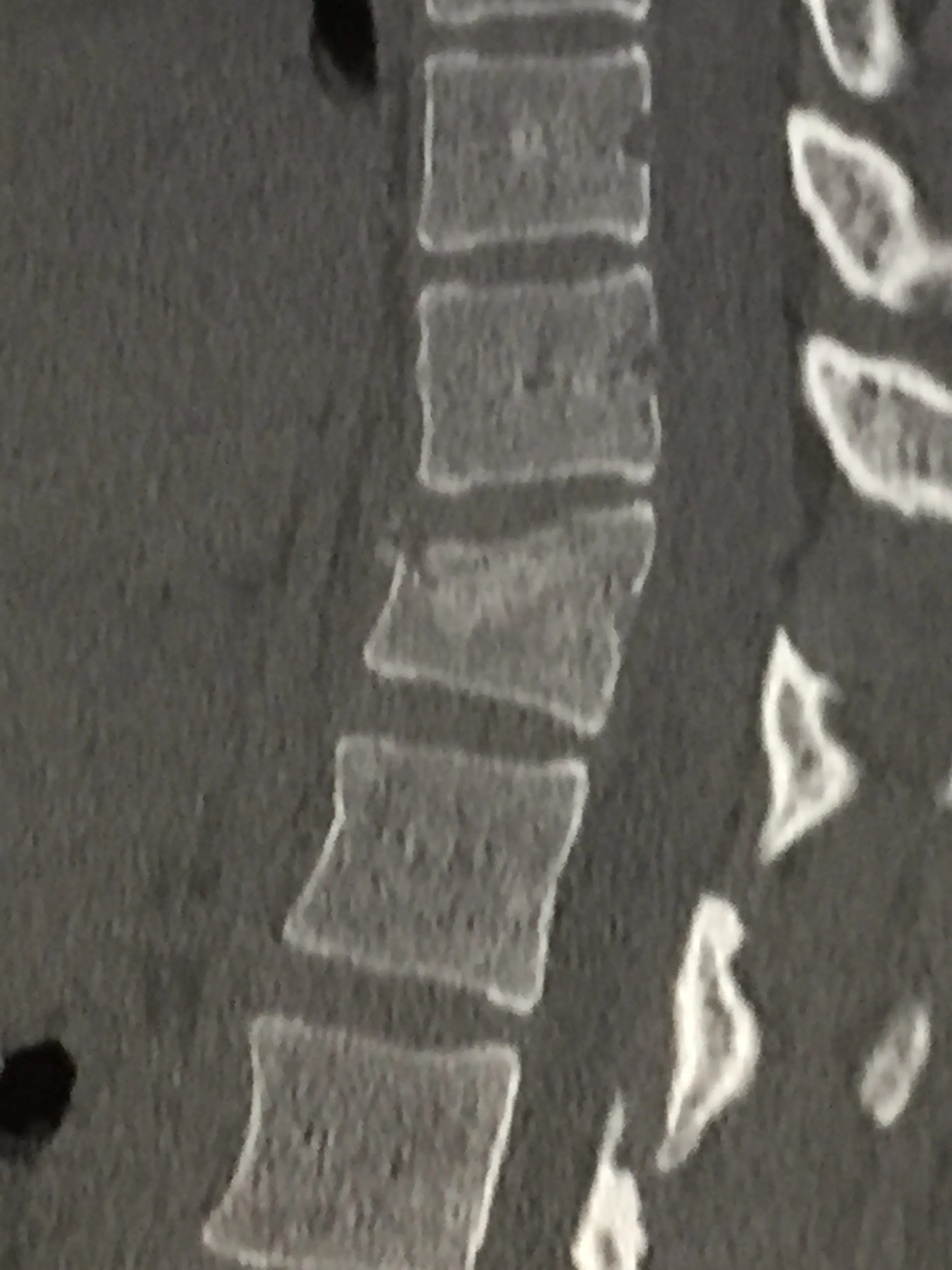 SpineJack1